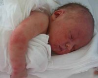 Патология кожи новорожденного ребенка thumbnail