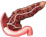 Что такое фиброзы в поджелудочной железе thumbnail
