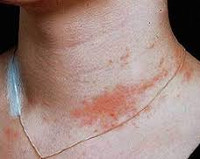 Аллергический контактный дерматит на металл thumbnail