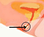 Воспаление парауретральных желез лечение thumbnail