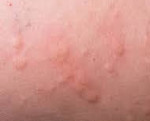 Аллергия на слизистой у мужчин thumbnail