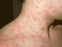 Аллергия на пенициллин симптомы у ребенка фото thumbnail