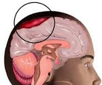 Субдуральная гематома правой гемисферы головного мозга thumbnail