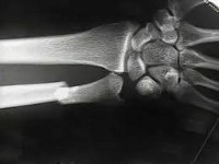 Перелом локтевой кости со смещением и смещением лучевой кости thumbnail