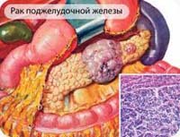 Рак тела поджелудочной железы диагностика thumbnail