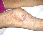 Лечение туберкулеза болят суставы thumbnail