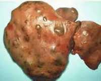 Фульминантная форма гепатита и ее лечение thumbnail