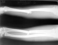 Перелом лучевой кости запястья: причины, симптомы, консервативное и оперативное лечение thumbnail