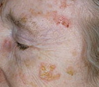 Актинический кератоз кожи лица лечение thumbnail