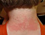 Причины возникновения солнечного дерматита thumbnail
