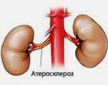 Атеросклерозы атеросклероз почечных артерий thumbnail