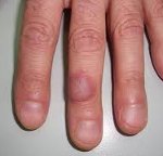 Травматический дерматит у человека thumbnail