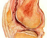 Артрит коленного сустава туберкулезный thumbnail