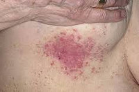 Кандидоз кожи лечение симптомы thumbnail