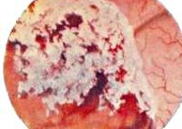 Локализация опухоли мочевого пузыря thumbnail