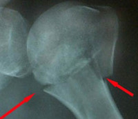 Перелом шейки плеча и его лечение thumbnail