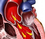 Гипертония при аортальной недостаточности thumbnail