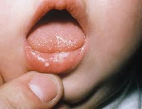 Герпетический стоматит у детей научная thumbnail