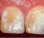 Эрозия эмали зубов причины лечение thumbnail