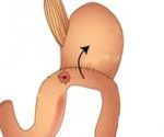 Пептические язвы оперированного желудка thumbnail