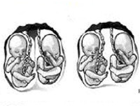 Побочное действие многоплодная беременность thumbnail