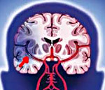 Топический диагноз инфаркт мозга thumbnail
