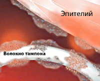 Острый синдром токсического шока вызван бактериальной инфекцией thumbnail