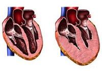 Гипертрофическая кардиомиопатия и атеросклероз thumbnail