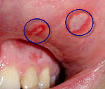 Медикаментозный стоматит с локализацией на нижней губе фото thumbnail