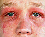 Аллергический дерматит на косметические средства thumbnail