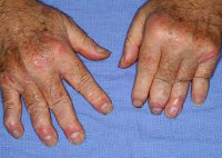 Клинические формы псориатического артрита thumbnail