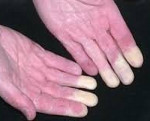 Синдром рейно при ревматоидном артрите thumbnail