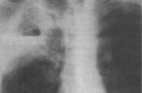 Профилактика гипостатической пневмонии у человека thumbnail