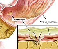 Симптомы пенетрации язвы в поджелудочную железу thumbnail