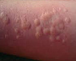Аллергическая сыпь по типу крапивницы thumbnail