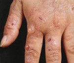 Поздняя кожная порфирия при гепатите с фото thumbnail