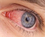 Синдром красного глаза лечение препараты thumbnail