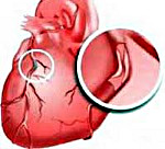 Что болит при ишемической болезни сердца thumbnail