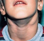 Воспаление лимфоузлов на шее у ребенка причины лечение без температуры thumbnail