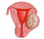 Лечение миомы матки с интерстициальным узлом thumbnail
