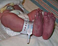 Синдром полицитемии у новорожденного что это thumbnail