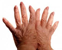 Болевой синдром при деформирующем остеоартрозе связан с thumbnail
