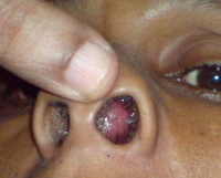 Гематома и абсцесс носовой перегородки: причины, симптомы, диагностика, лечение thumbnail
