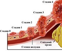 Рак желудка причины симптомы лечение thumbnail