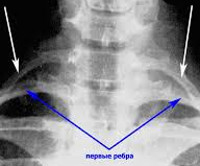 Рентген шейное ребро позвоночника thumbnail