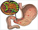 Хронический гастродуоденит язва желудка thumbnail