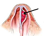Заболевание носовой перегородки гематома абсцесс искривление thumbnail