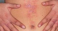 Простой контактный дерматит возникает при thumbnail