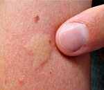 Аллергия на укусы насекомых и его лечение thumbnail