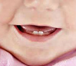 Синдром прорезывания зубов у детей лечение thumbnail